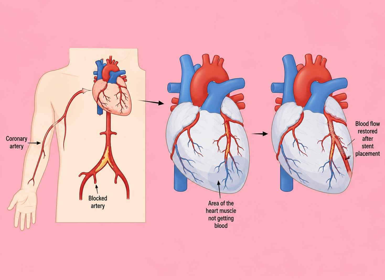 Art of Cannulating Coronary Arteries