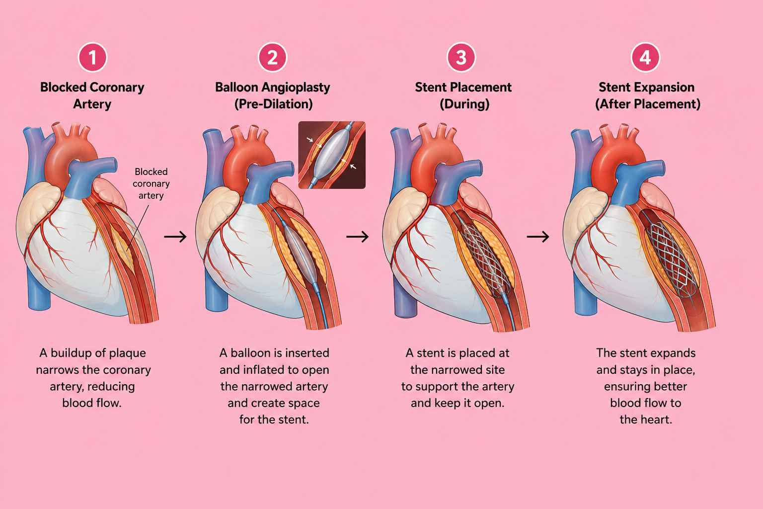 Coronary PCI with an Indegenous IVL