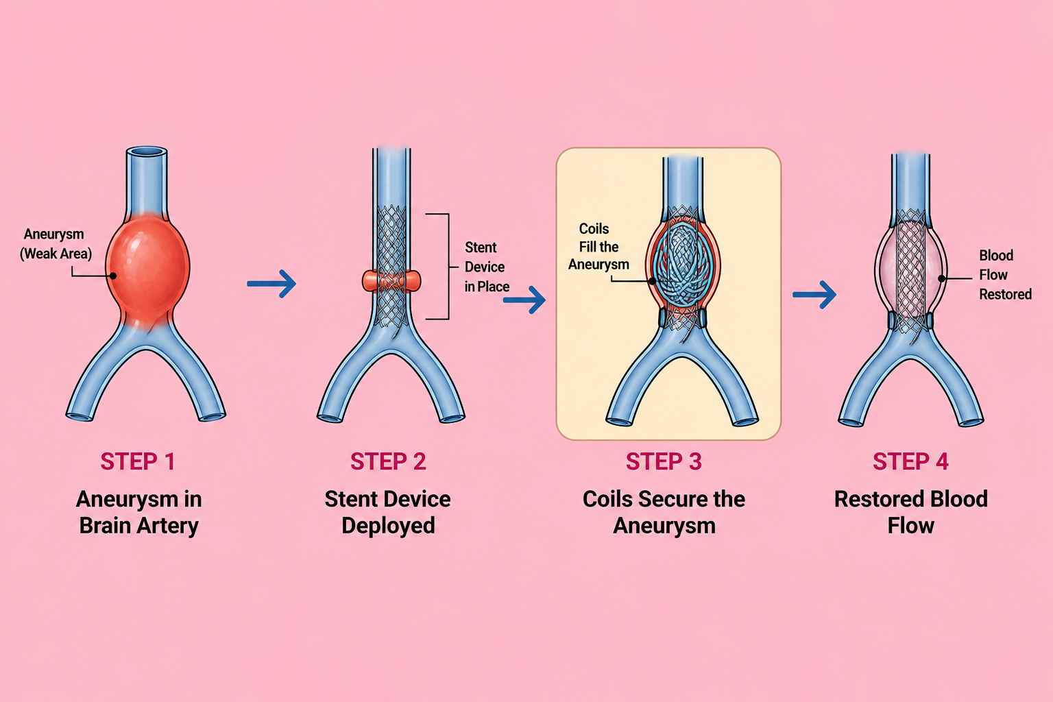 EVAR in Abdominal Aortic Aneurysm