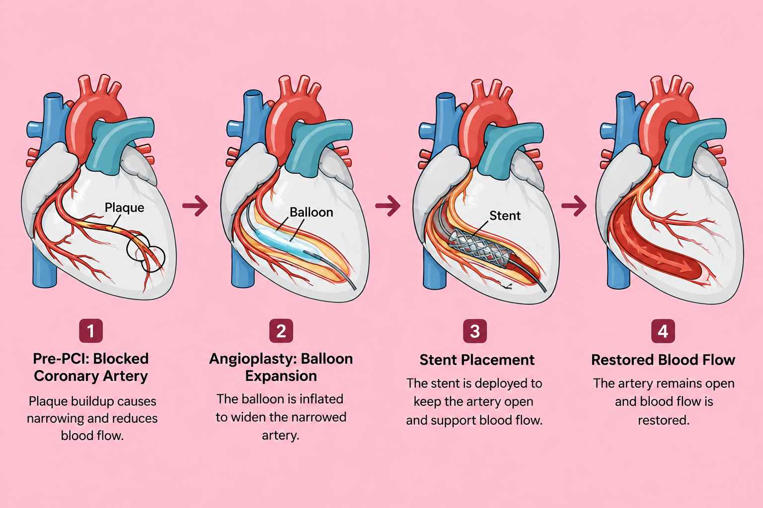 Facilitated ADR in Post-CABG RCA CTO