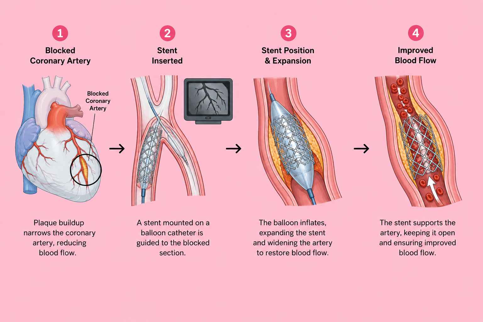 IVUS-GUIDED Multivessel PCI with RCA CTO PCI