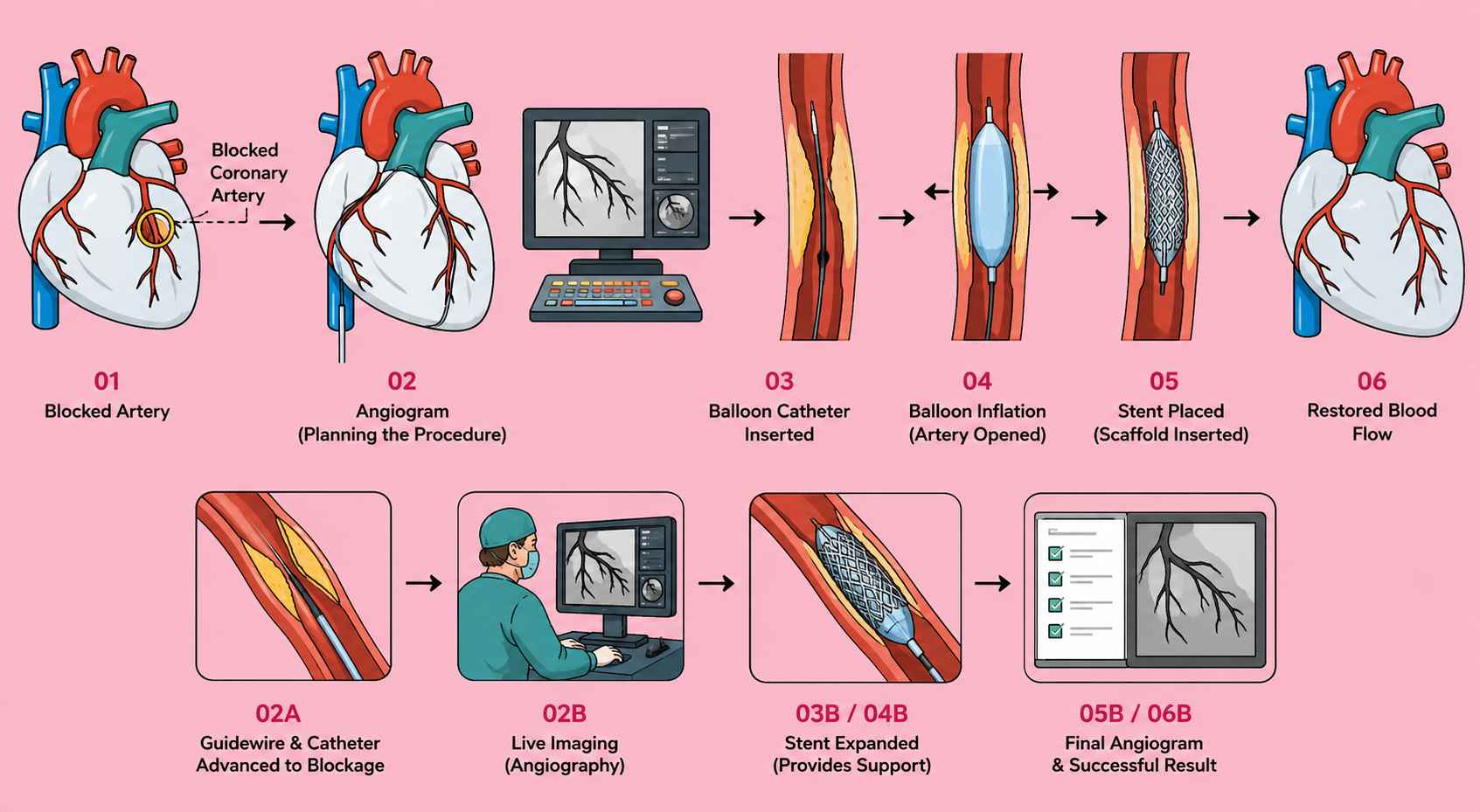 Navigating Complex Angioplasty: Insights and Innovations