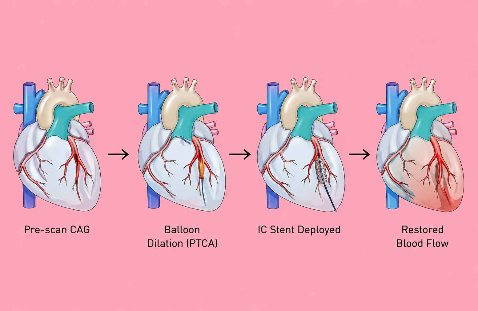 A Retired Professor’s Story of Resilience | Post – CABG CTO PCI