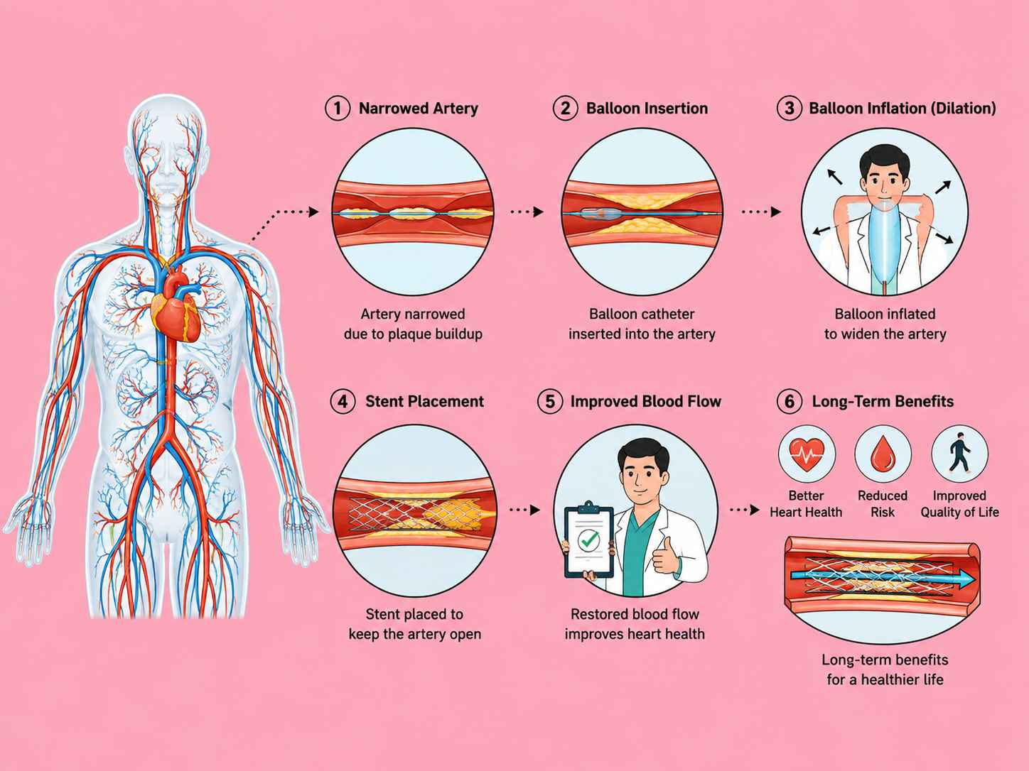 Understanding Chronic Total Occlusion of Blood Vessels