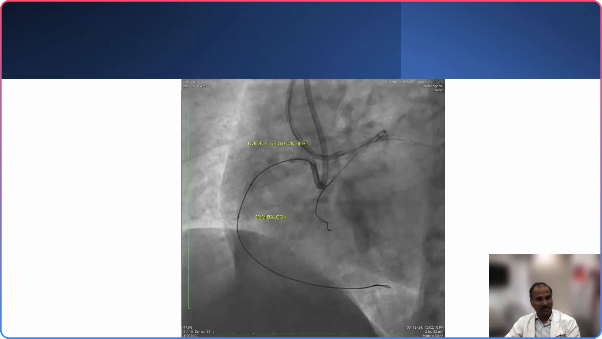 Challenges in Anomalous Right Coronary Artery Cases