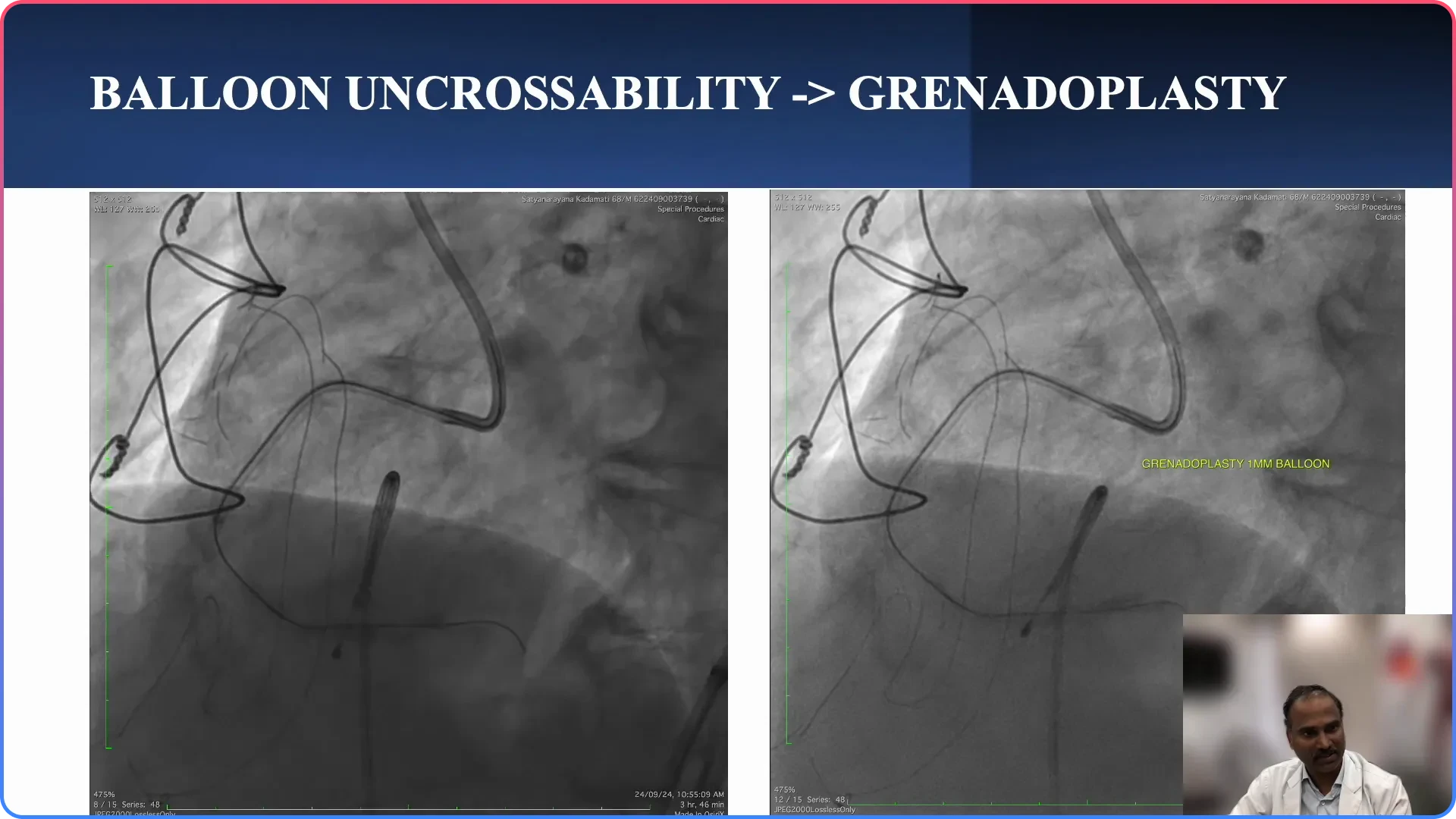 Grenado Plasty Technique and Observations