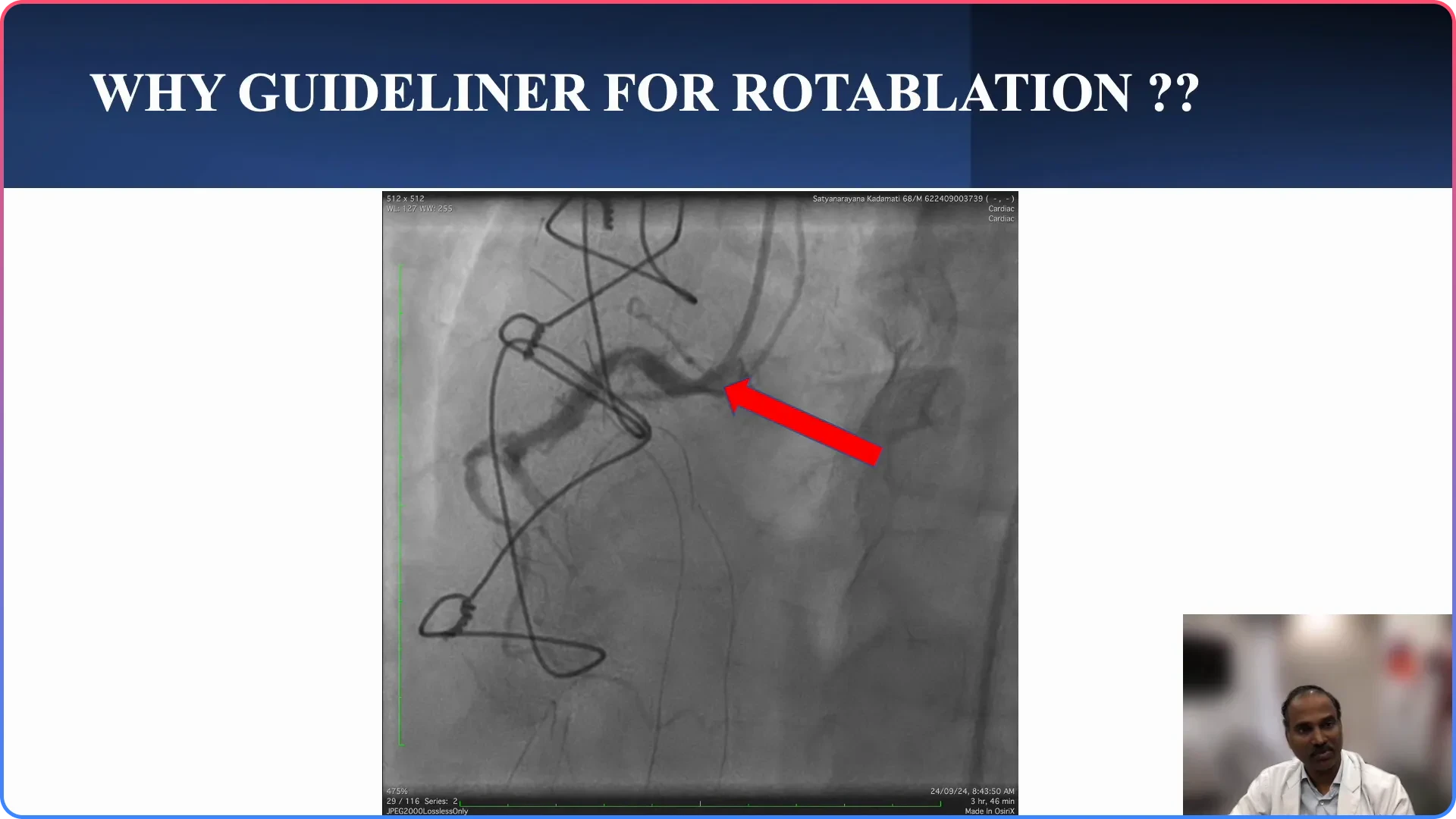 The Role of Guide Extension in Rotablation
