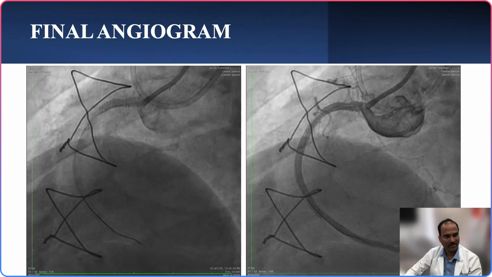 Stenting Outcome