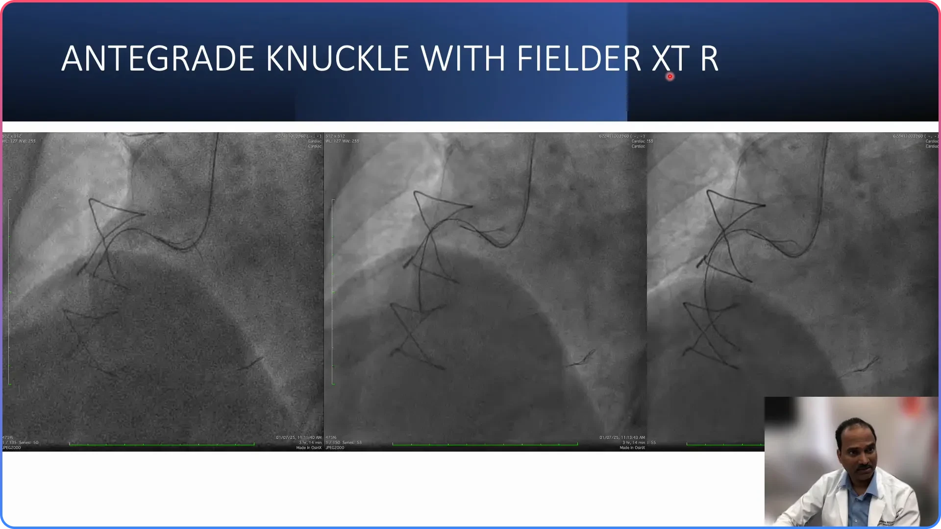 Knuckle Wire Technique