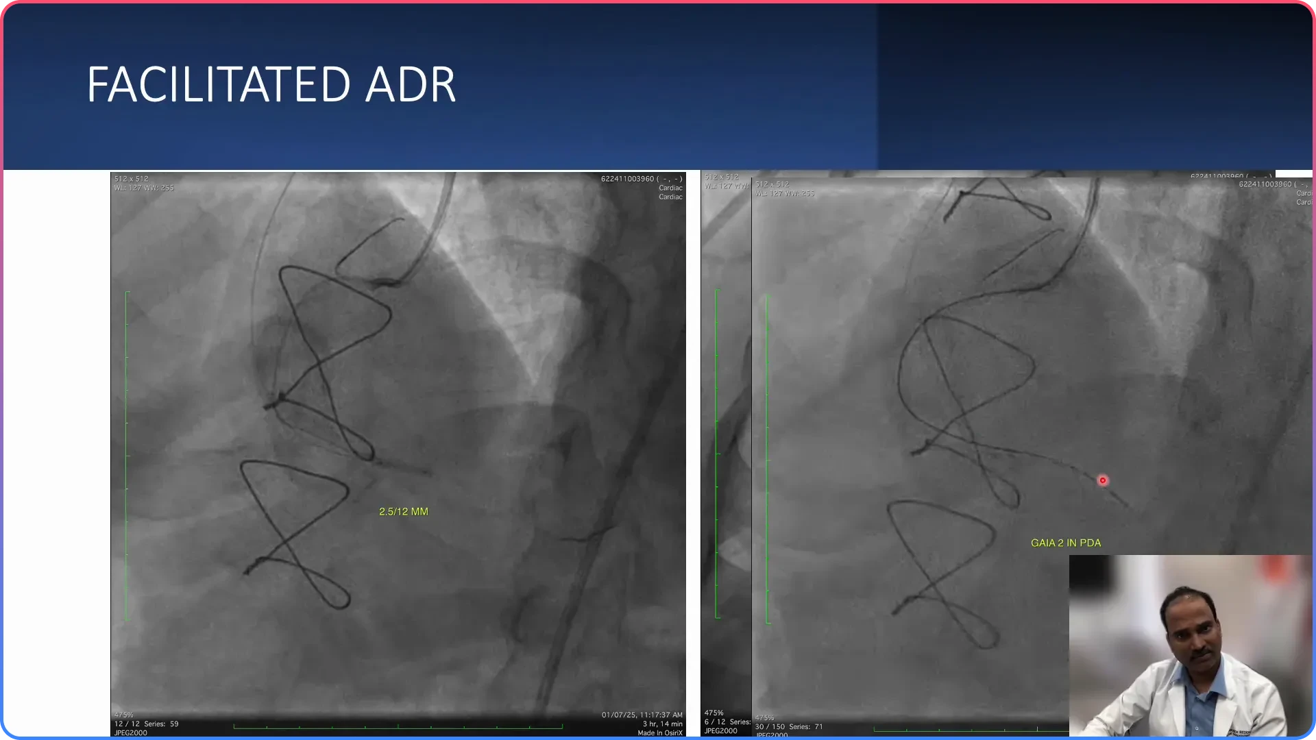 Re-entry Proximal to Crux
