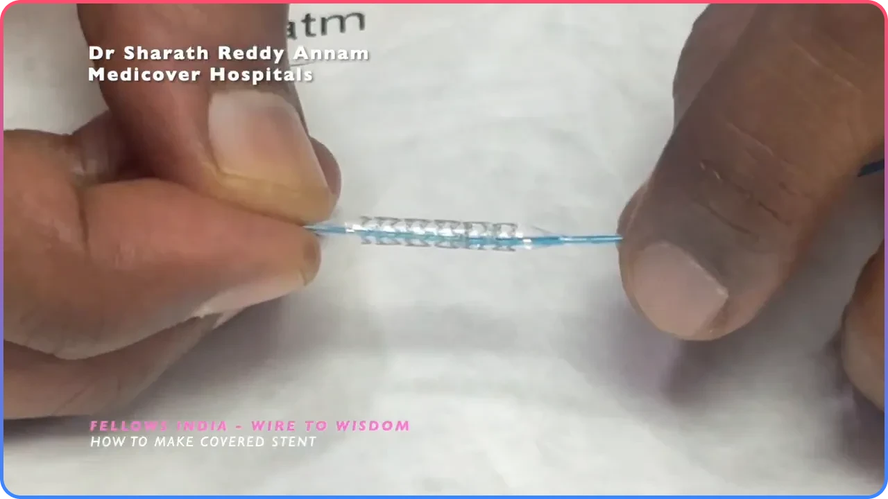 Select Stents