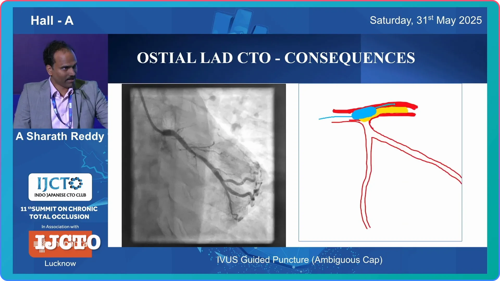 Importance of IVUS