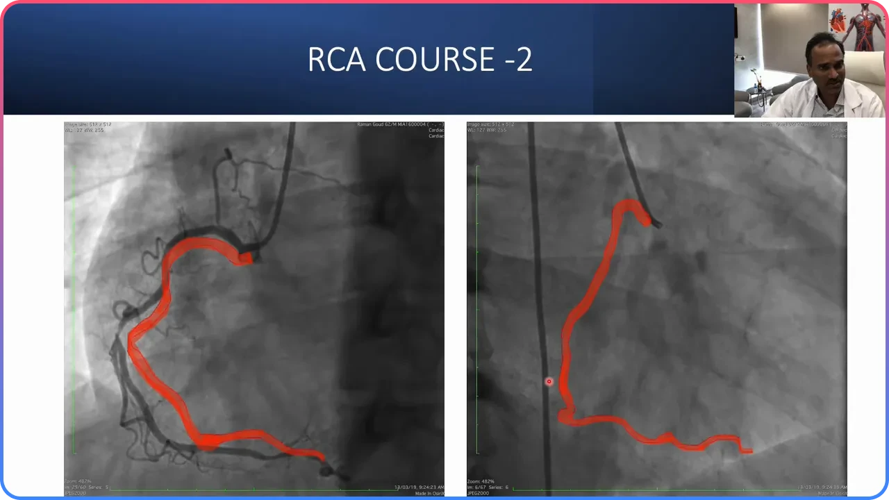 Confusing RCA Courses