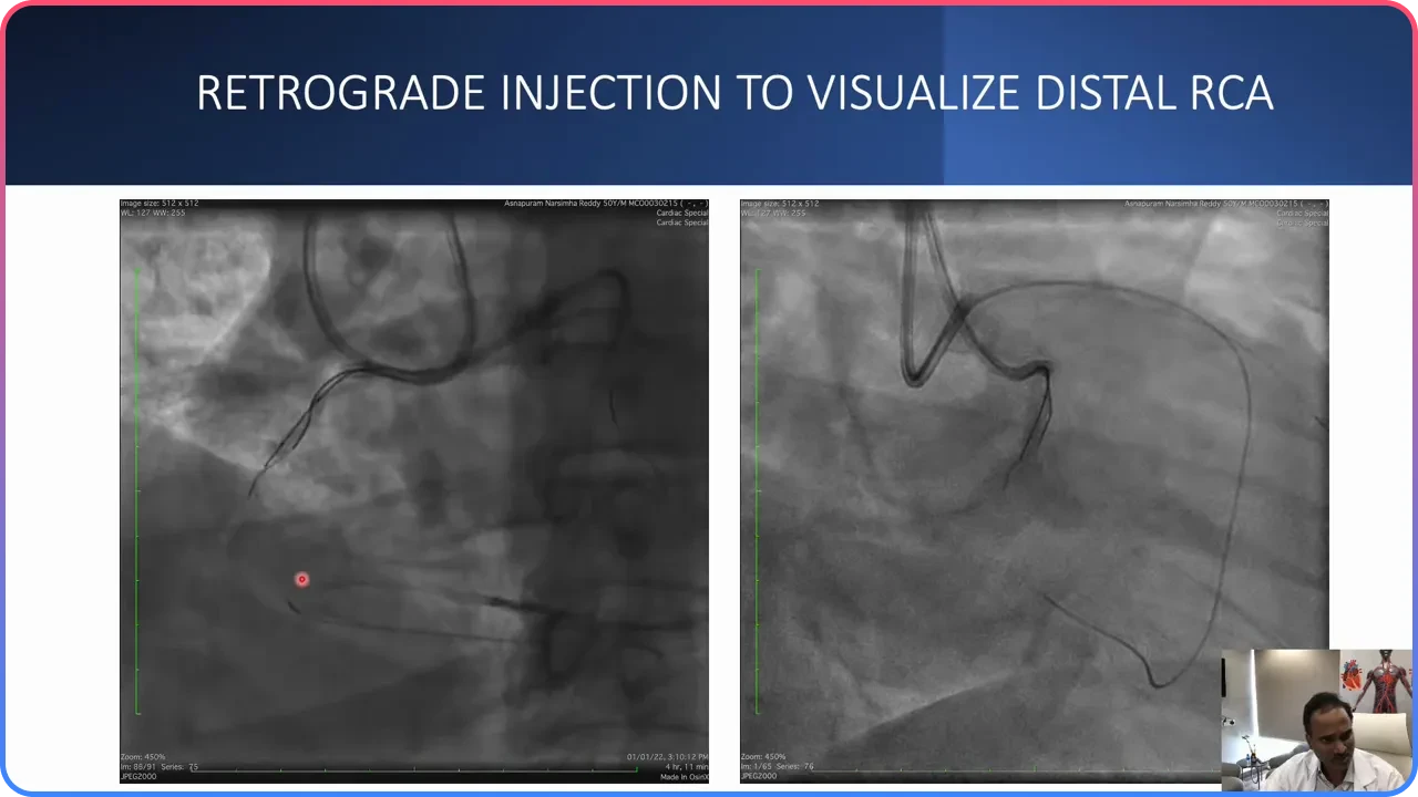 Retrograde Injection