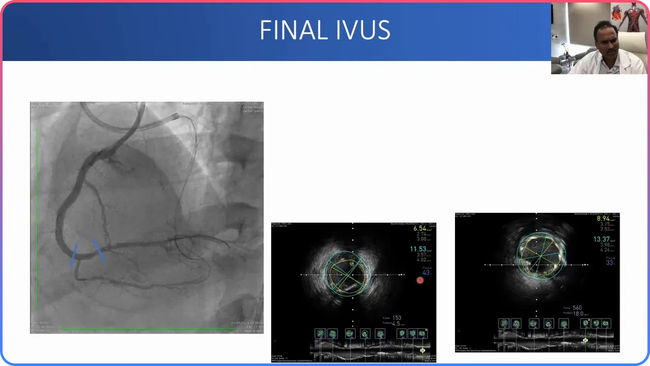 IVUS Optimization 1