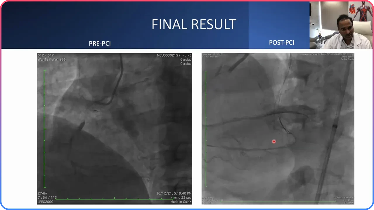 IVUS Optimization 2