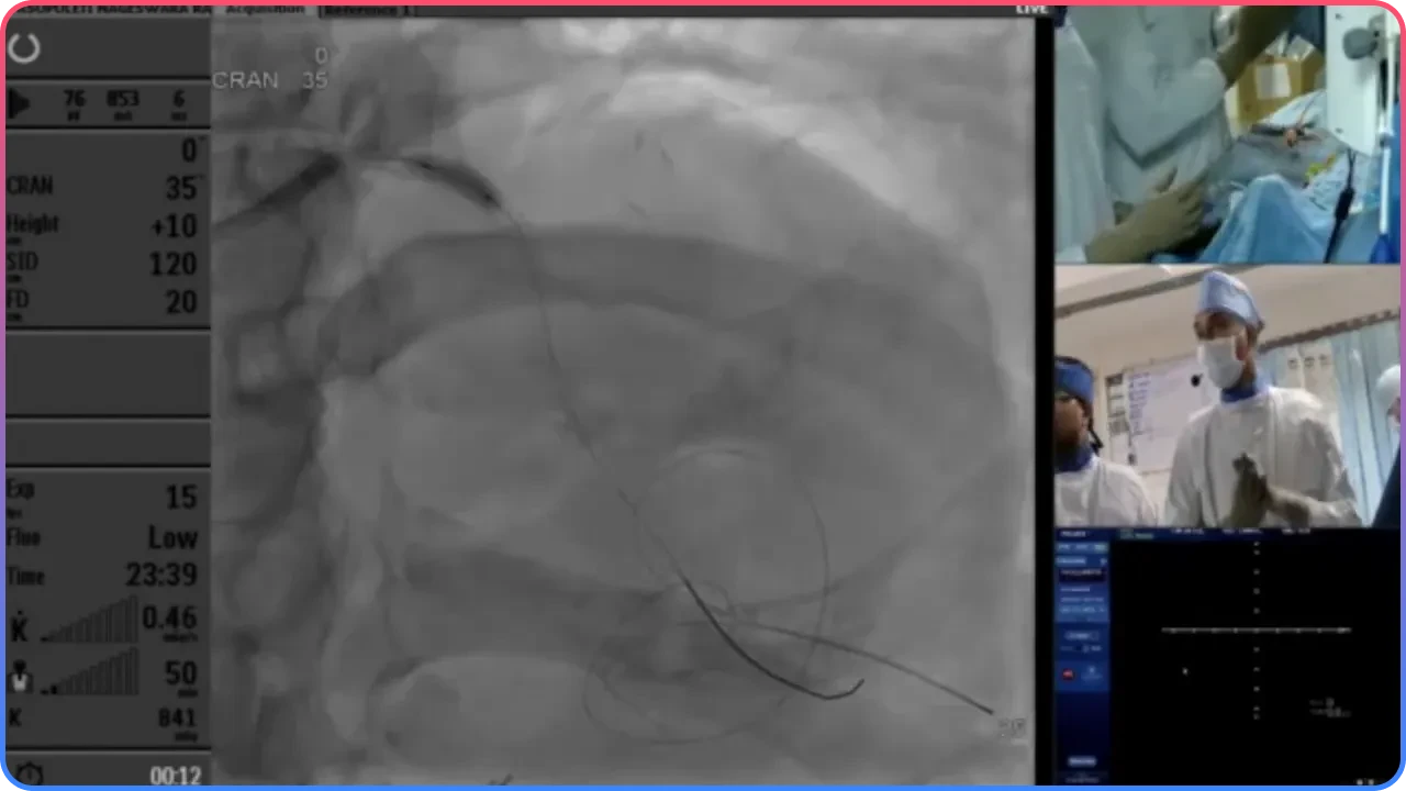 Post-Dilation and Stenting Strategy