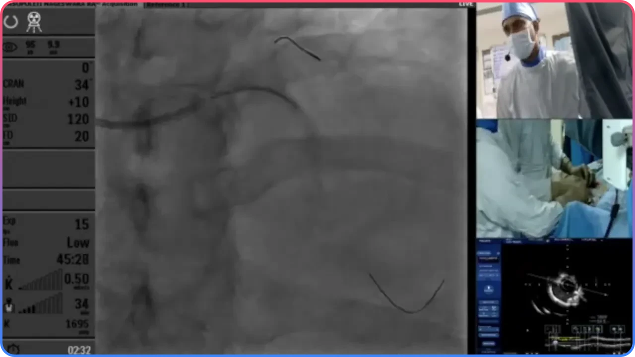 Final Stent Deployment