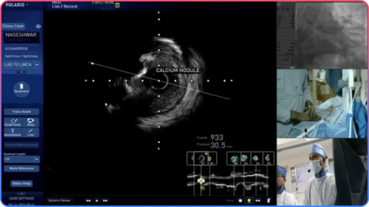 Identifying Calcium Nodules