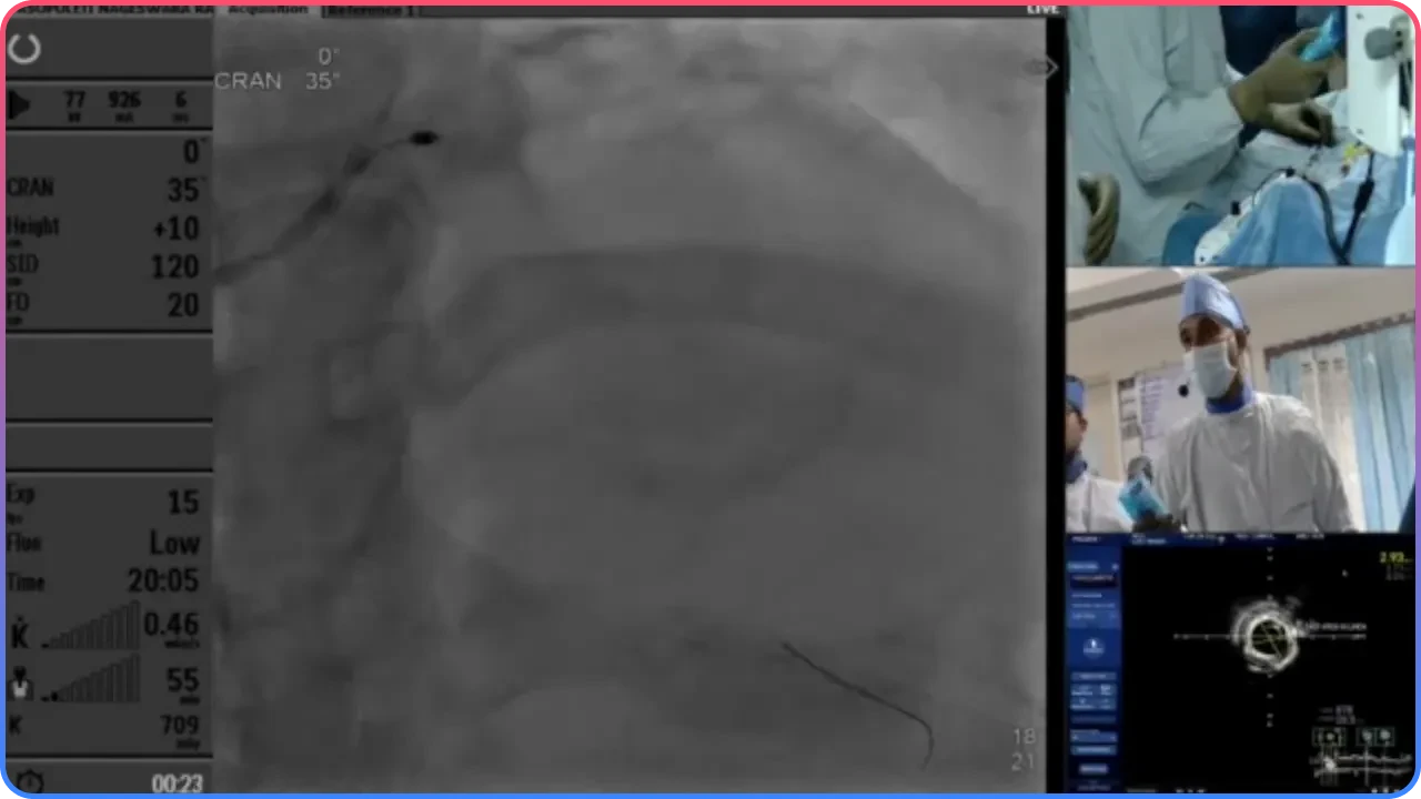 Balloon Angioplasty Considerations