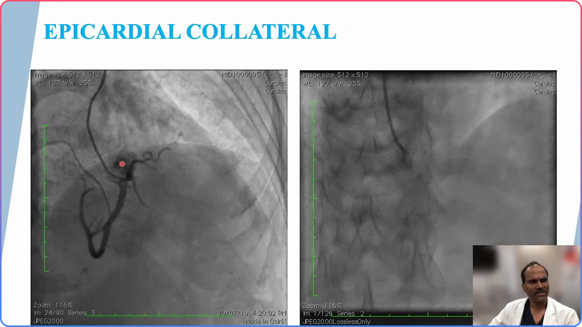 Interventional Collateral Selection