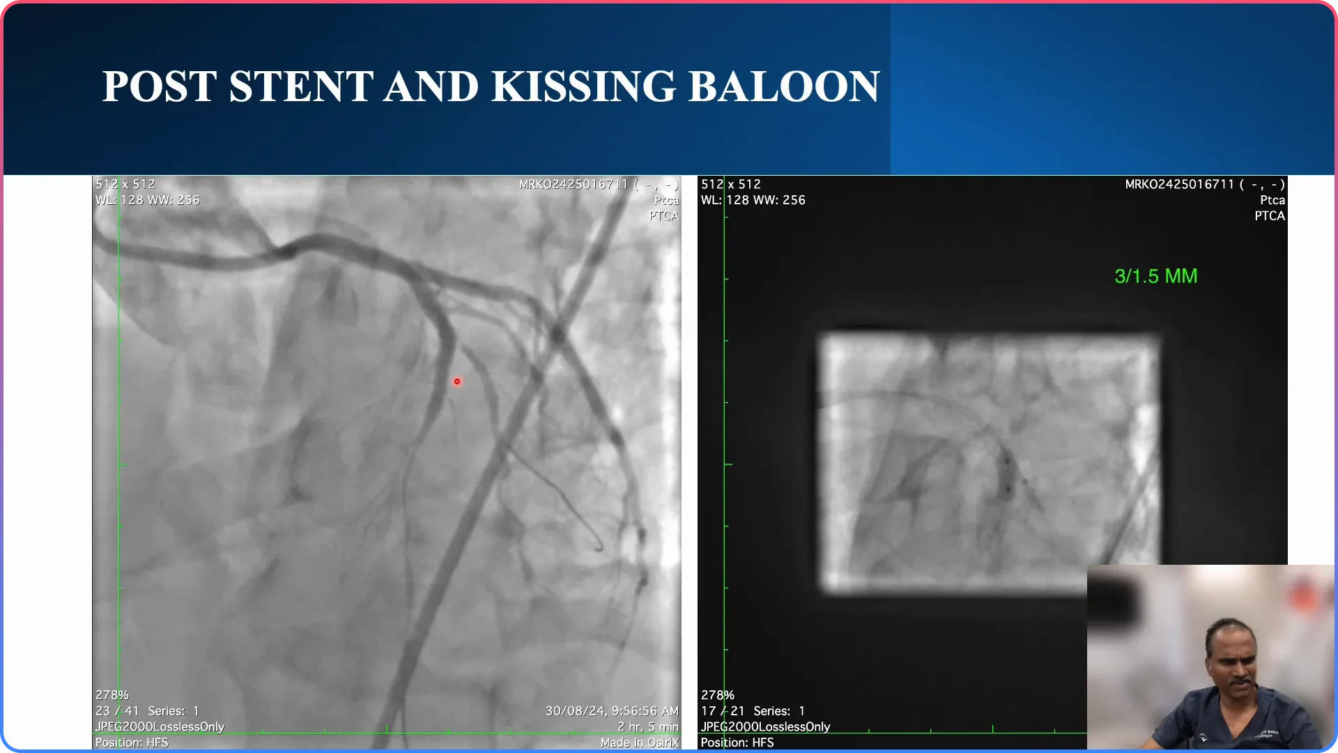 Post-Procedure Analysis and Stenting