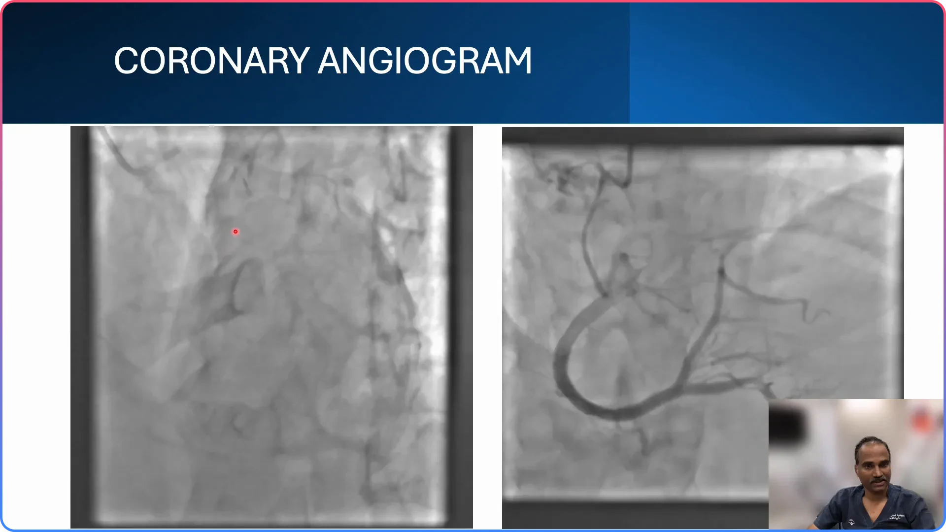 Understanding the Angiogram