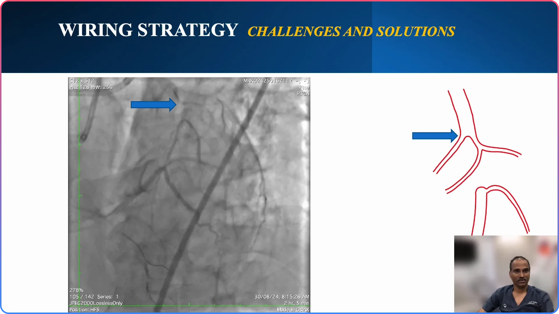 Challenges in CTO PCI