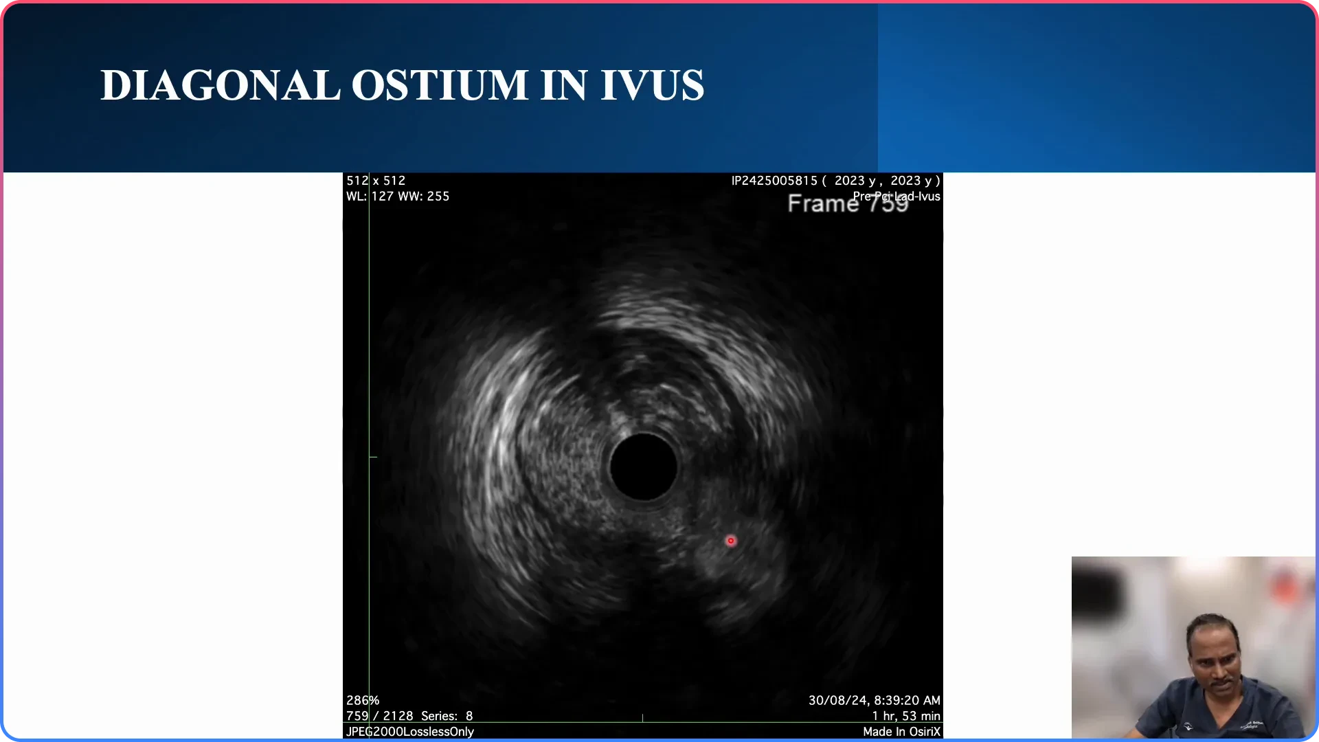 Identifying the Diagonal Osteum Flap