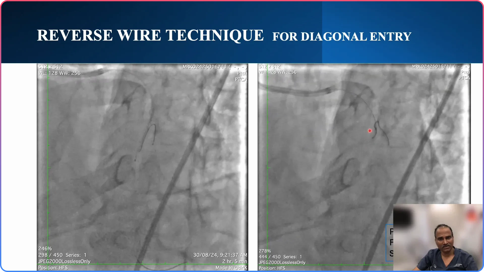 Executing the Reverse Wire Technique