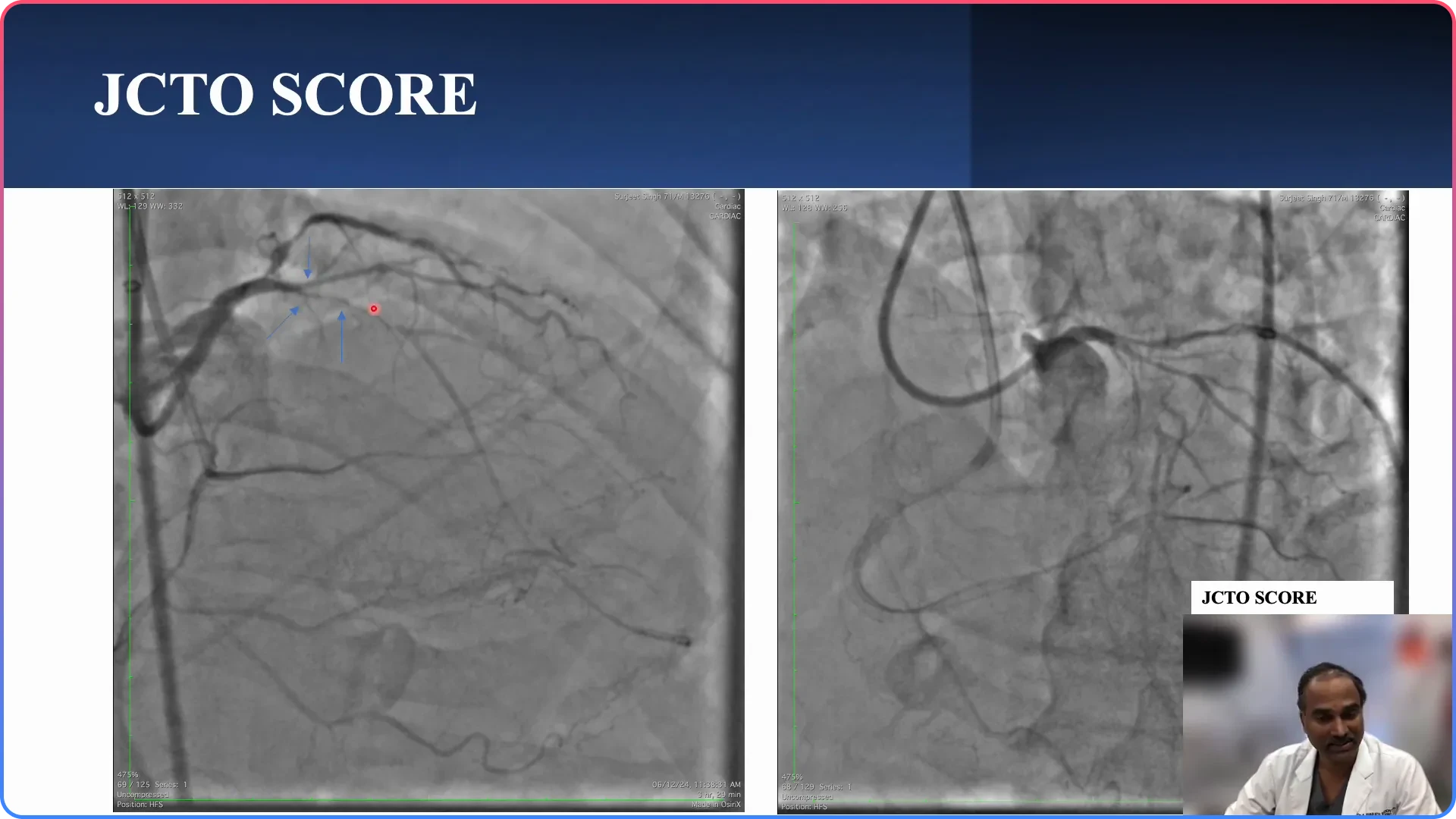 Understanding the Proximal Cap