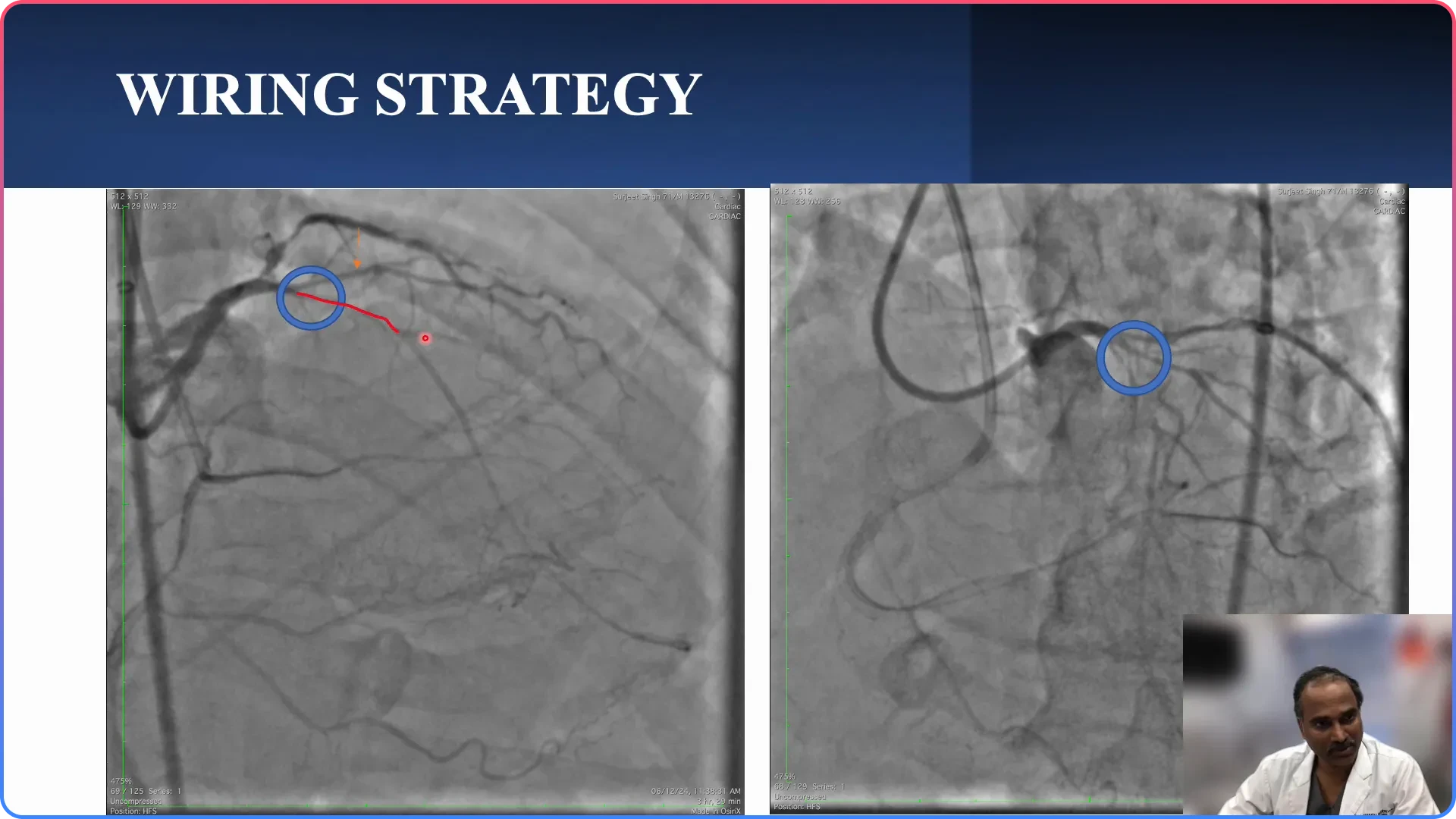 Wiring Strategy for Ambiguous Cap