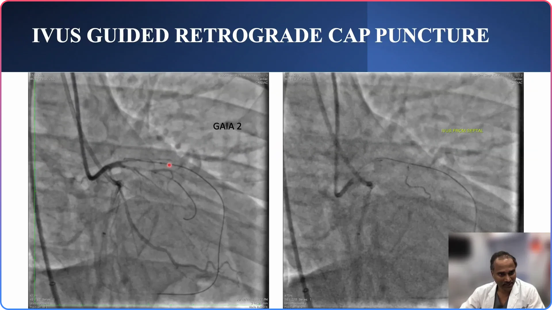 Confirming the Distal Cap