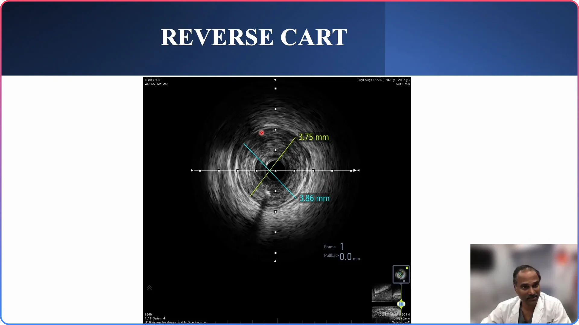 Principles of Reverse Cut Technique