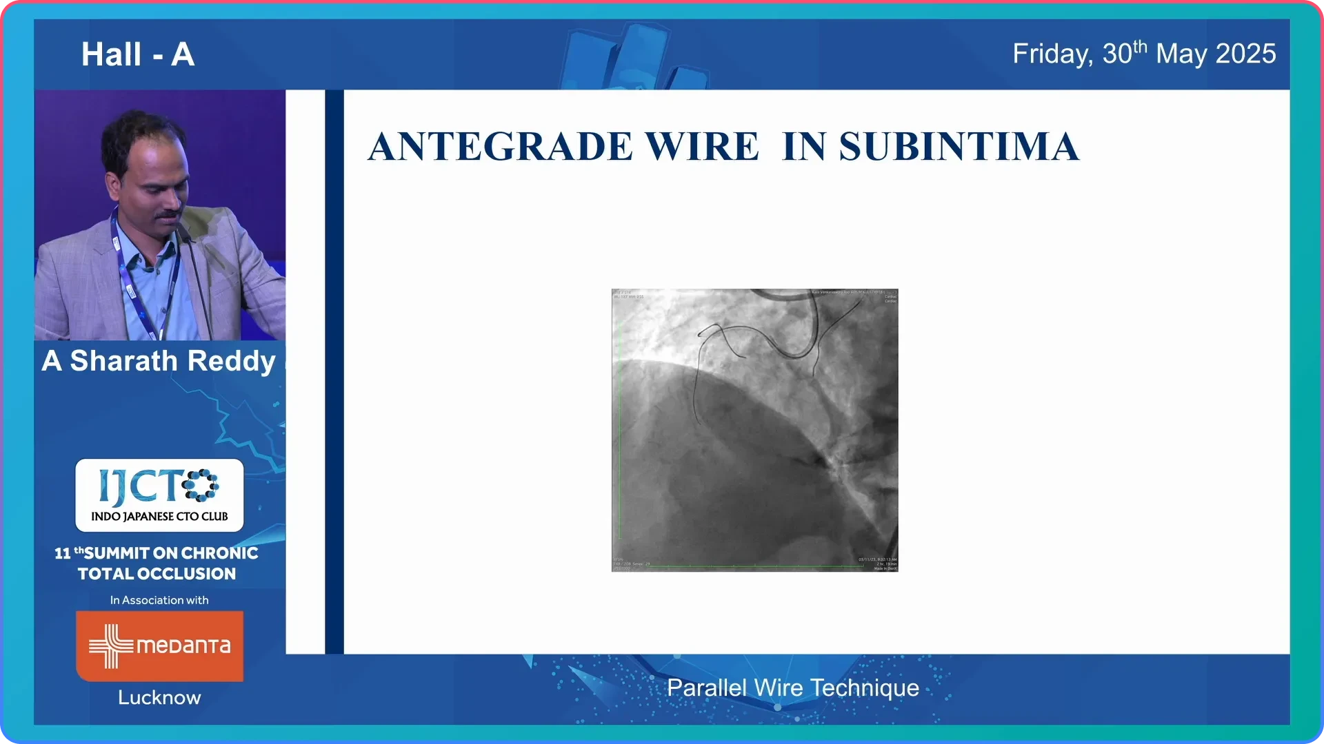 Parallel Wire Technique