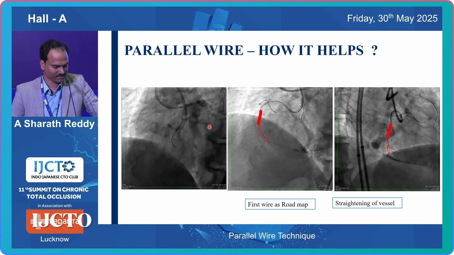 Parallel Wire Technique Work