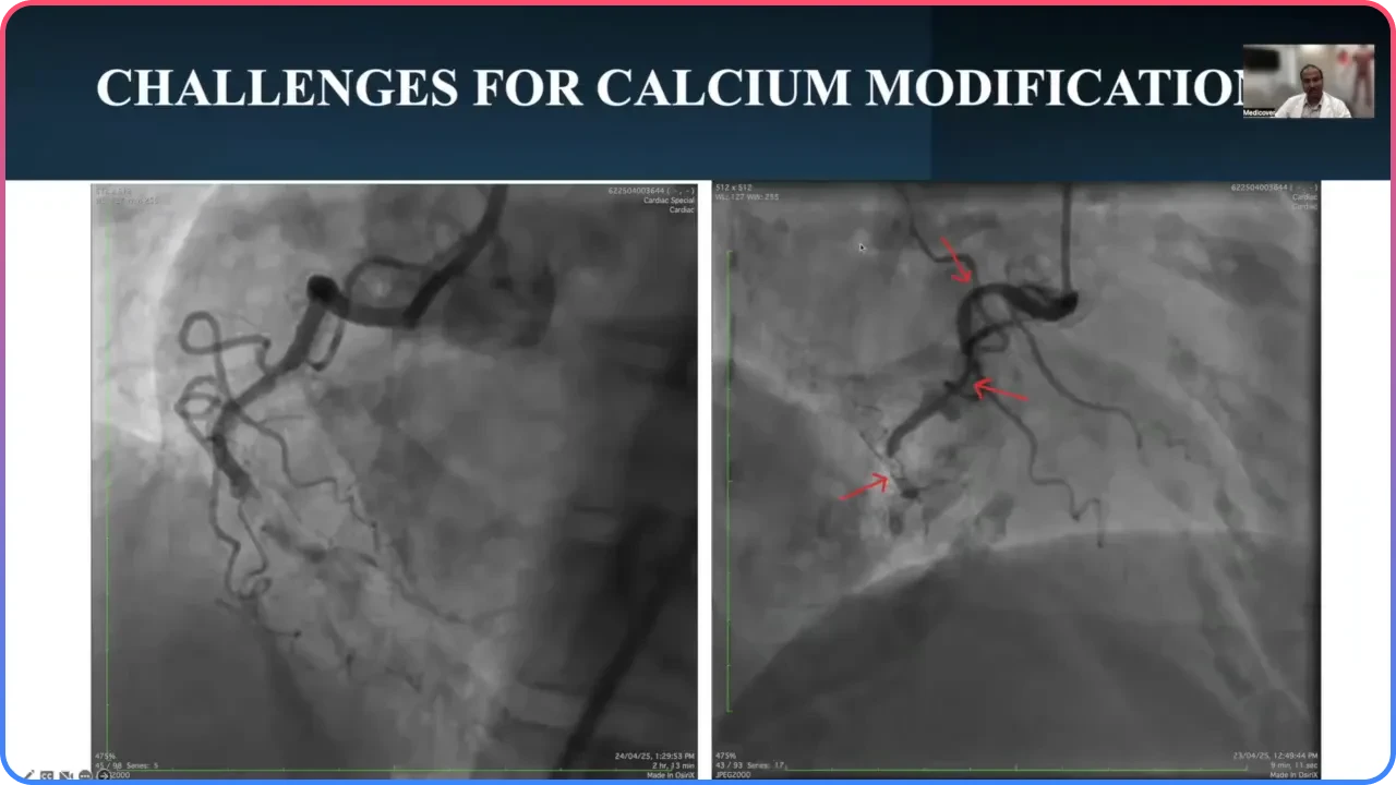 Tortuous Calcified RCA