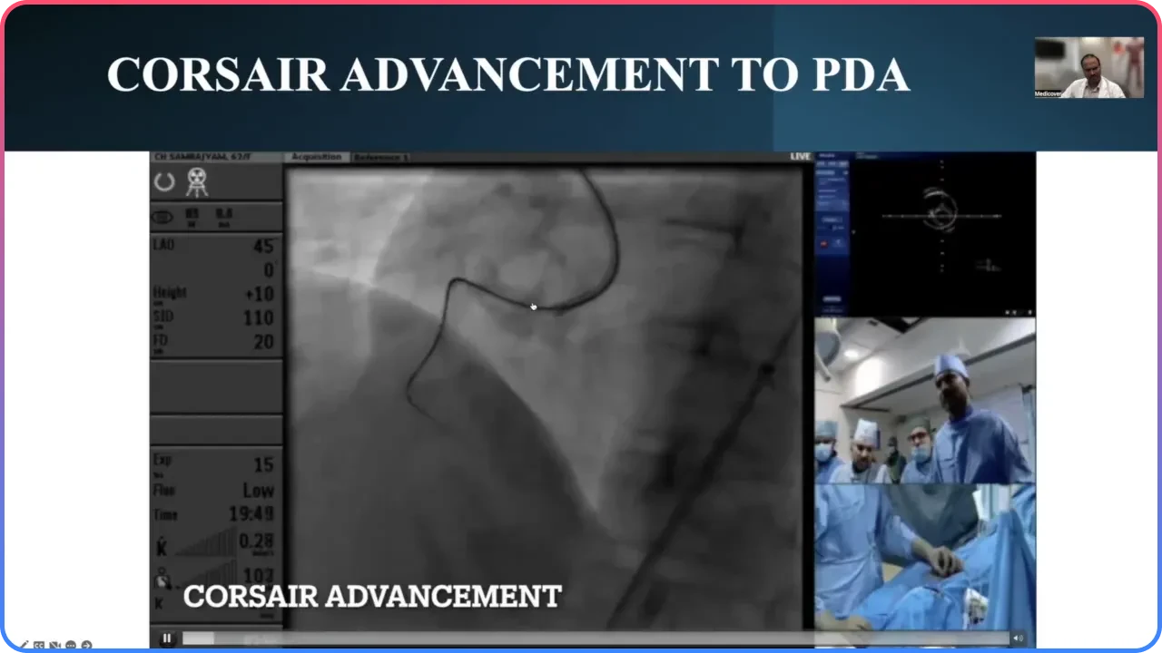 Corsair Catheter