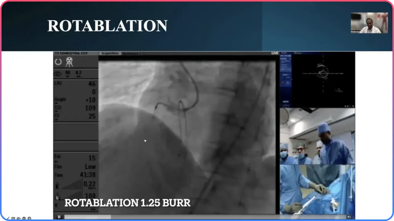 Rotablation Procedure