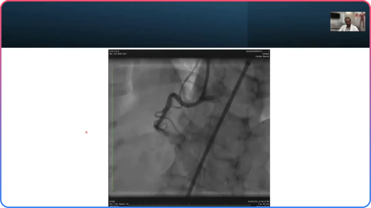 Stenting