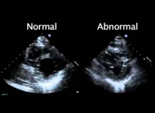 Echocardiography