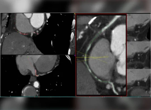 CT Angiogram