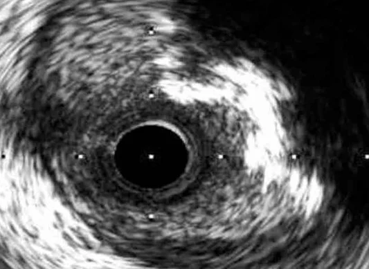 Intravascular Ultrasound (IVUS)