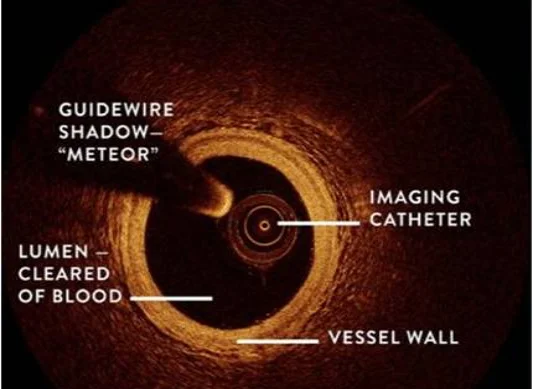 Optical Coherence Tomography (OCT)