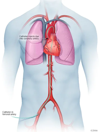Coronary Angiogram