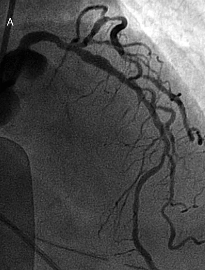 Discomforts During the Procedure