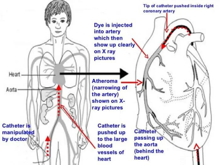 After the Procedure