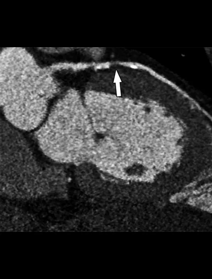 During the CT Angiography Procedure