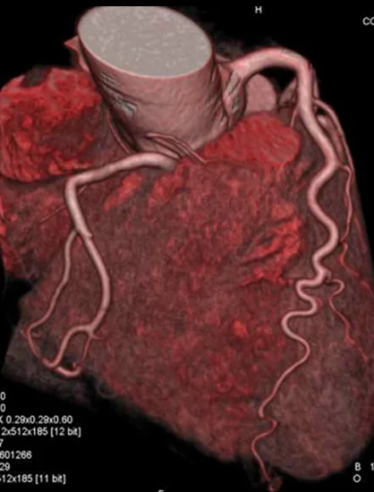 After the CT Angiography Procedure