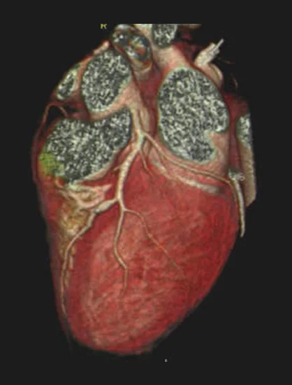 CT Angiography Results